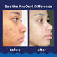PanOxyl 10% Benzoyl Peroxide Acne Foaming Wash – Maximum Strength Face & Body Cleanser 5.5 oz
